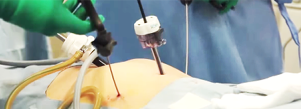 腹腔鏡手術の有効性画像