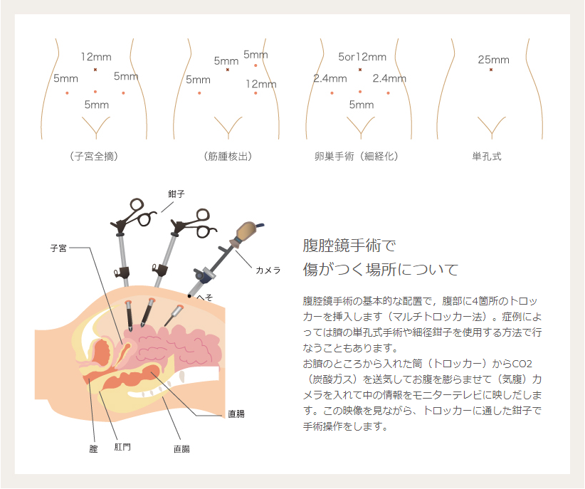 腹腔鏡手術で傷がつく場所について