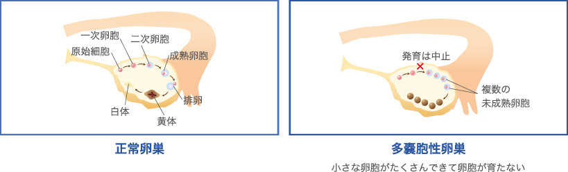 多嚢胞性卵巣症候群画像