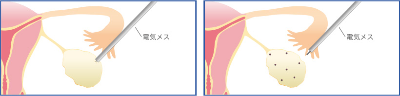 多嚢胞性卵巣症候群（PCOS）の治療画像