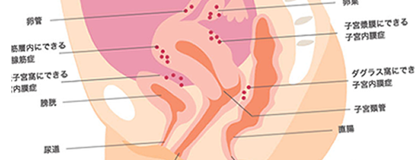 子宮内膜症イメージ画像
