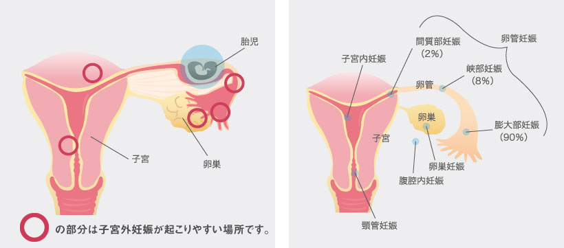 異所性（子宮外）妊娠画像