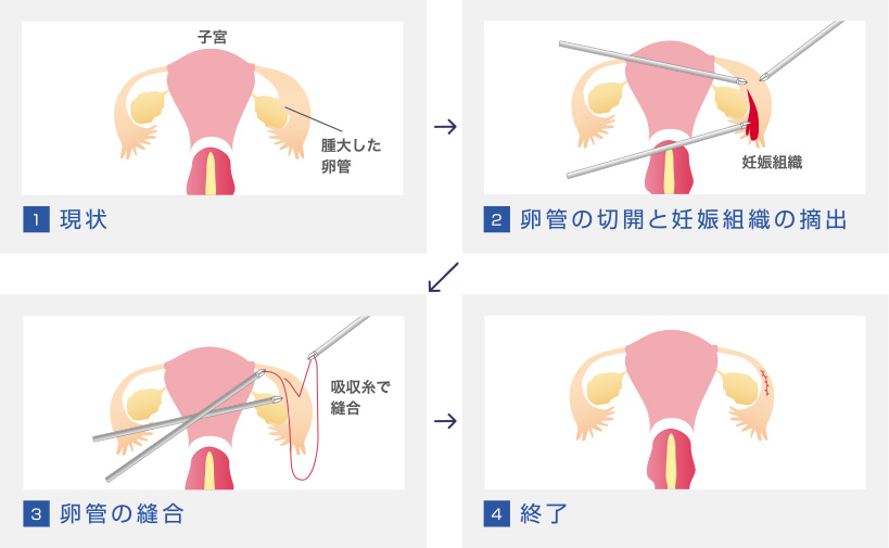 異所性（子宮外）妊娠の腹腔鏡手術画像