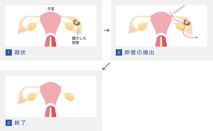異所性（子宮外）妊娠の卵管摘出画像