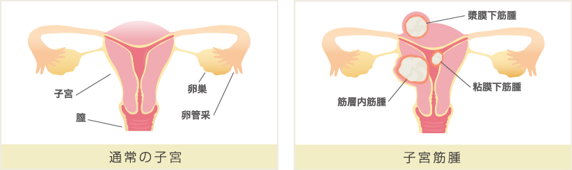 子宮筋腫画像