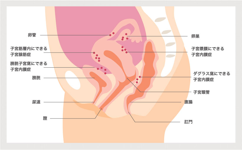 子宮内膜症ができやすい場所画像