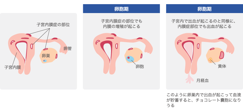 子宮内膜症の病態について画像