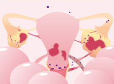 子宮内膜症の進行 stage3