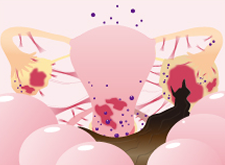 子宮内膜症の進行 stage4