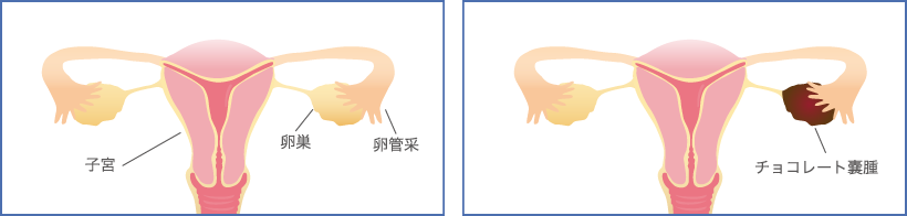 子宮内膜症の病態について画像