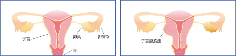 子宮腺筋症の病態について画像