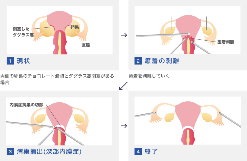 子宮内膜症での腹腔鏡手術（ダグラス窩閉塞など）画像